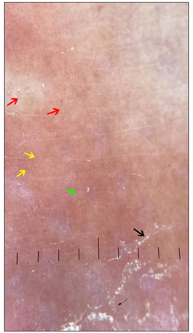 Dermoscopy of the leg lesion revealed scales (black arrow), with distortion of pigment network (red arrow), and dotted (yellow arrow) or fine linear vessels (green arrow) in an orange-yellowish background on the right lower limb (polarising 10x).